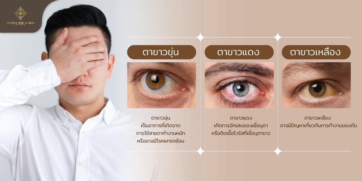 ตาขาวขุ่น ตาขาวแดง ตาขาวเหลือง เกิดจากอะไร บอกโรคอะไรบ้าง