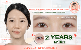 Double Eyelid Surgery Review