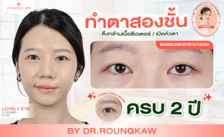 รีวิวทำตาสองชั้น