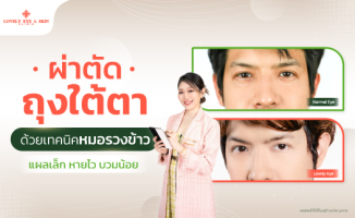 ผ่าตัดถุงใต้ตาด้วยเทคนิคหมอรวงข้าว แผลเล็ก หายไว บวมน้อย