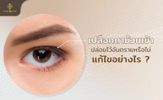 เปลือกตาม้วนเข้า